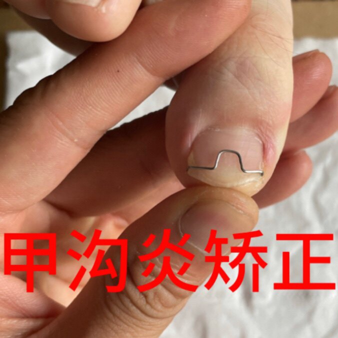 甲沟矫正专用品